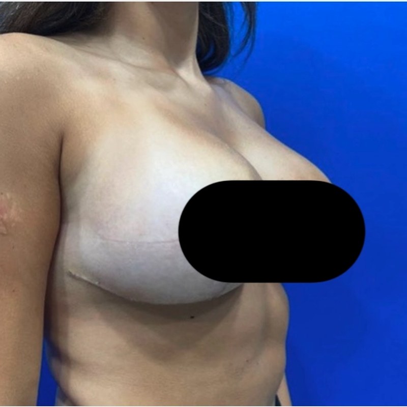 After breast reduction — Oblique