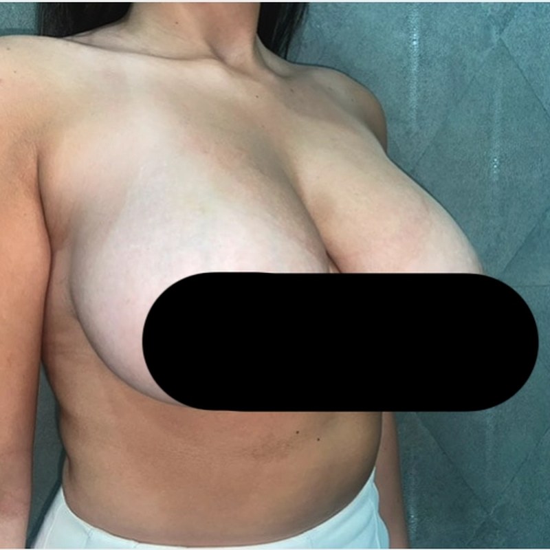 Before breast reduction — Oblique