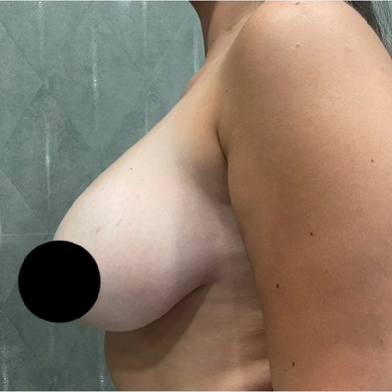 Before breast reduction — Side profile