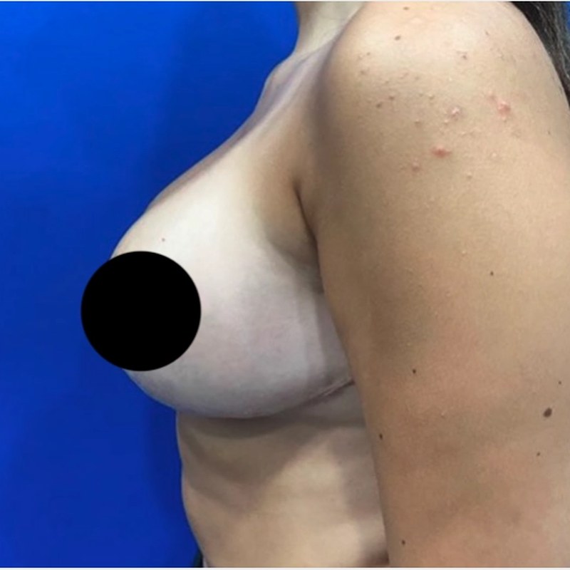 After breast reduction — Side profile